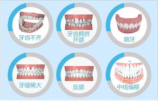 整牙什么时候打支抗钉（隐适美打支抗钉*）